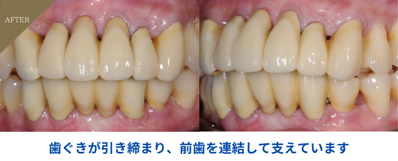 28歳女性・歯周炎（重度）
