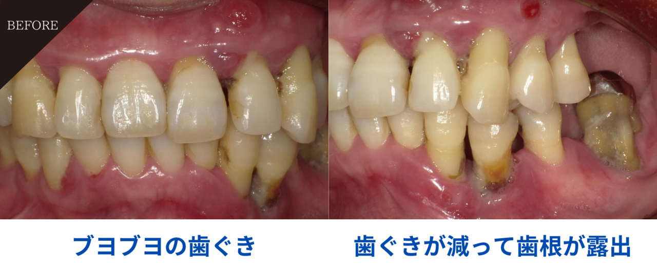 50歳女性・歯周炎（重度）