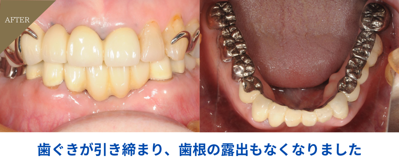 57歳男性・歯周炎(中度)の症例