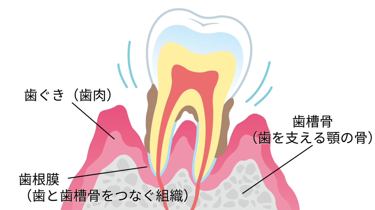 歯周病とは