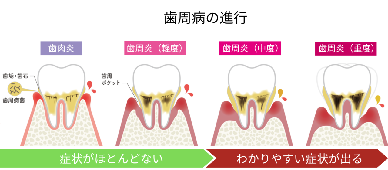 歯周病の進行・手遅れになると歯が抜ける