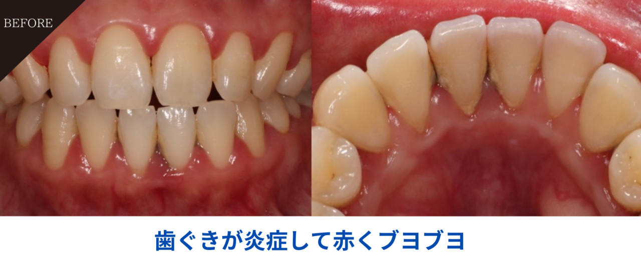 37歳女性・歯周炎(軽度)の症例