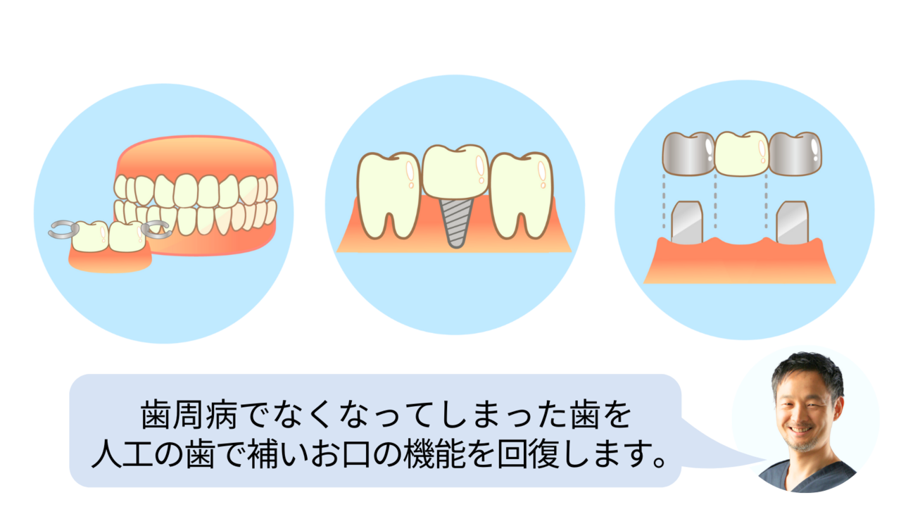 歯周病でなくなってしまった歯を 人工の歯で補いお口の機能を回復します。