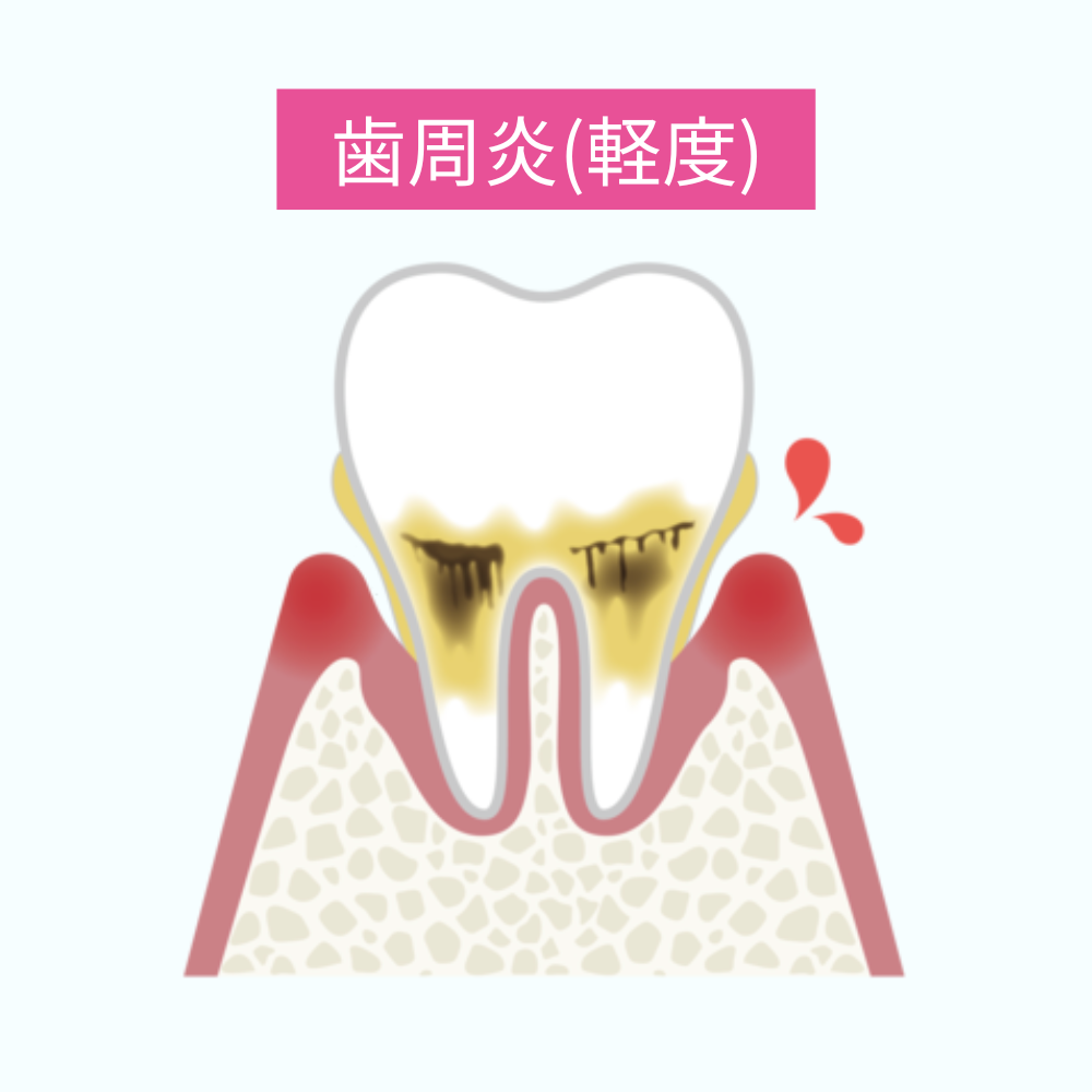 軽度の歯周炎