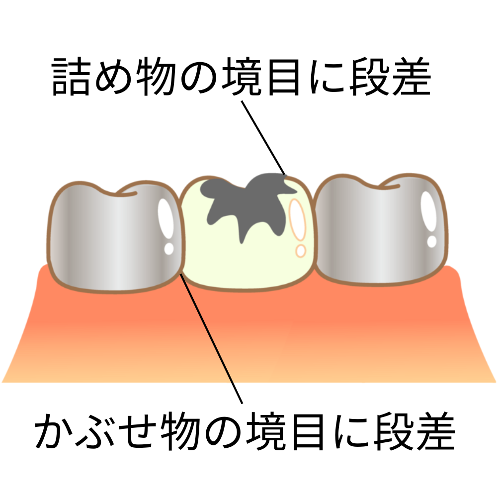 不適合な詰め物や被せ物の修正