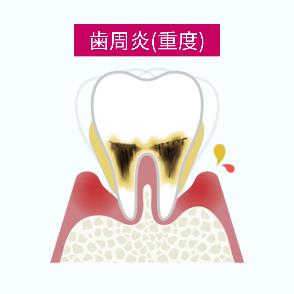 重度の歯周炎