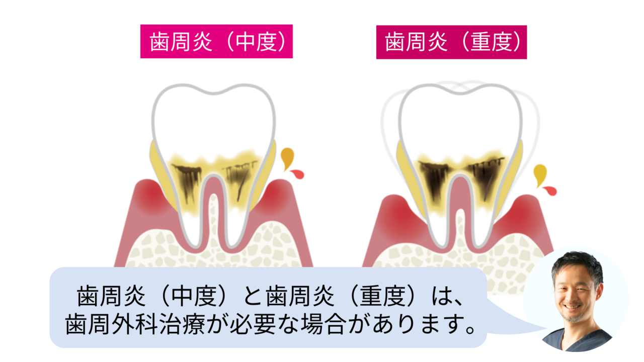 歯周炎（中度）と歯周炎（重度）は、 歯周外科治療が必要な場合があります。