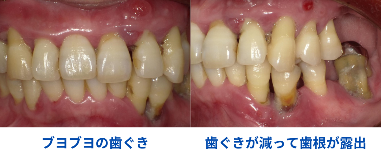 重度の歯周炎・手遅れの一歩手前の症状