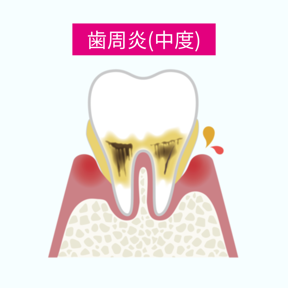 軽度の歯周炎