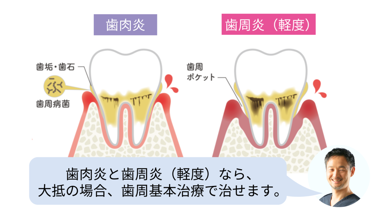 歯肉炎と歯周炎（軽度）なら、 大抵の場合、歯周基本治療で治せます。