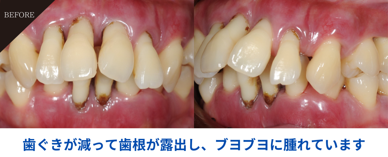 28歳女性・歯周炎（重度）