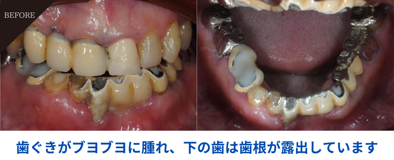 57歳男性・歯周炎(中度)の症例