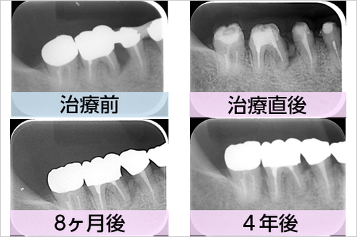 リグロスとは 名古屋でリグロス治療なら つゆくさ歯科医院 名古屋市緑区