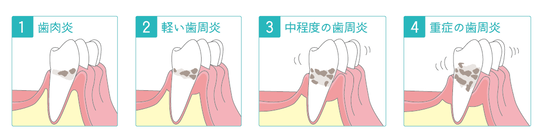 が 痒い 歯茎 歯がかゆい？その原因を簡単解説！