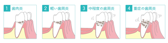 固い もの を 噛む と 歯 が 痛い