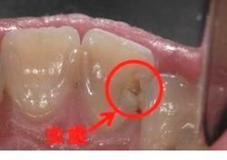 虫歯などで部分的に欠けてしまった歯を修理して噛めるようにする治療 歯冠修復治療 つゆくさ歯科医院 名古屋市緑区の歯医者