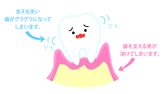 歯科医院ではどのように歯周病治療するの 名古屋市のつゆくさ歯科医院 歯周病相談室