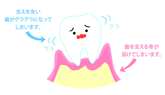 歯科医院ではどのように歯周病治療するの つゆくさ歯科医院 名古屋市緑区の歯医者 歯科医院ではどのように歯周病治療するの つゆくさ歯科医院 名古屋市緑区の歯医者