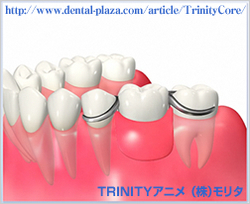 インプラント治療とは つゆくさ歯科医院 名古屋市緑区の歯医者