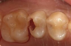 虫歯などで部分的に欠けてしまった歯を修理して噛めるようにする治療 歯冠修復治療 つゆくさ歯科医院 名古屋市緑区の歯医者